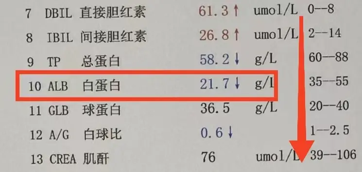 上周接诊了一位菏泽的患者，60多了，白蛋白降到了20多，据本人说反复腹...