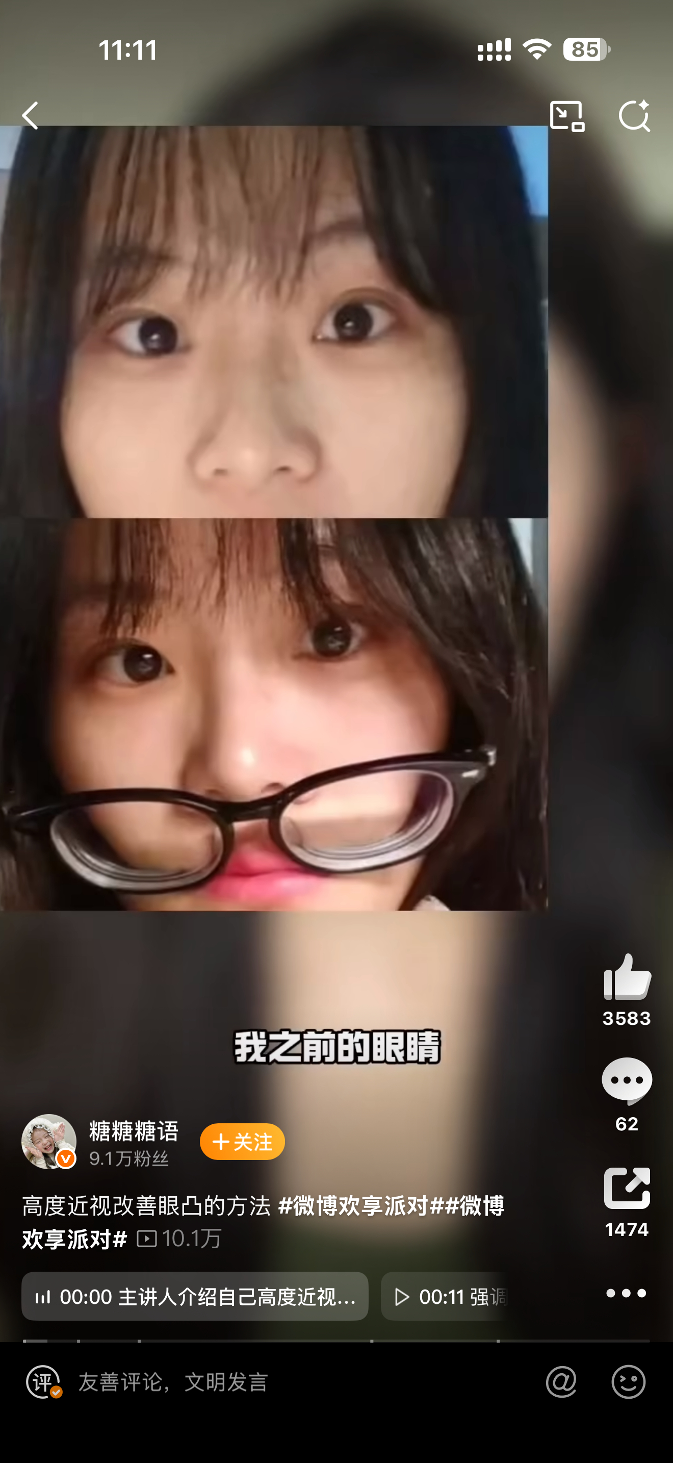 高度近视改善眼凸的方法还记得我一个同学，天生近视，一只眼刚出生近视600°，当时