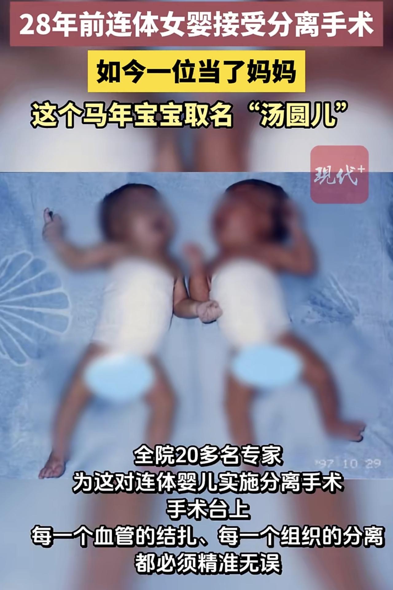 28年前，一对连体女婴在南通大学附属医院躺上了手术台，这是一场关乎生死的生命接力