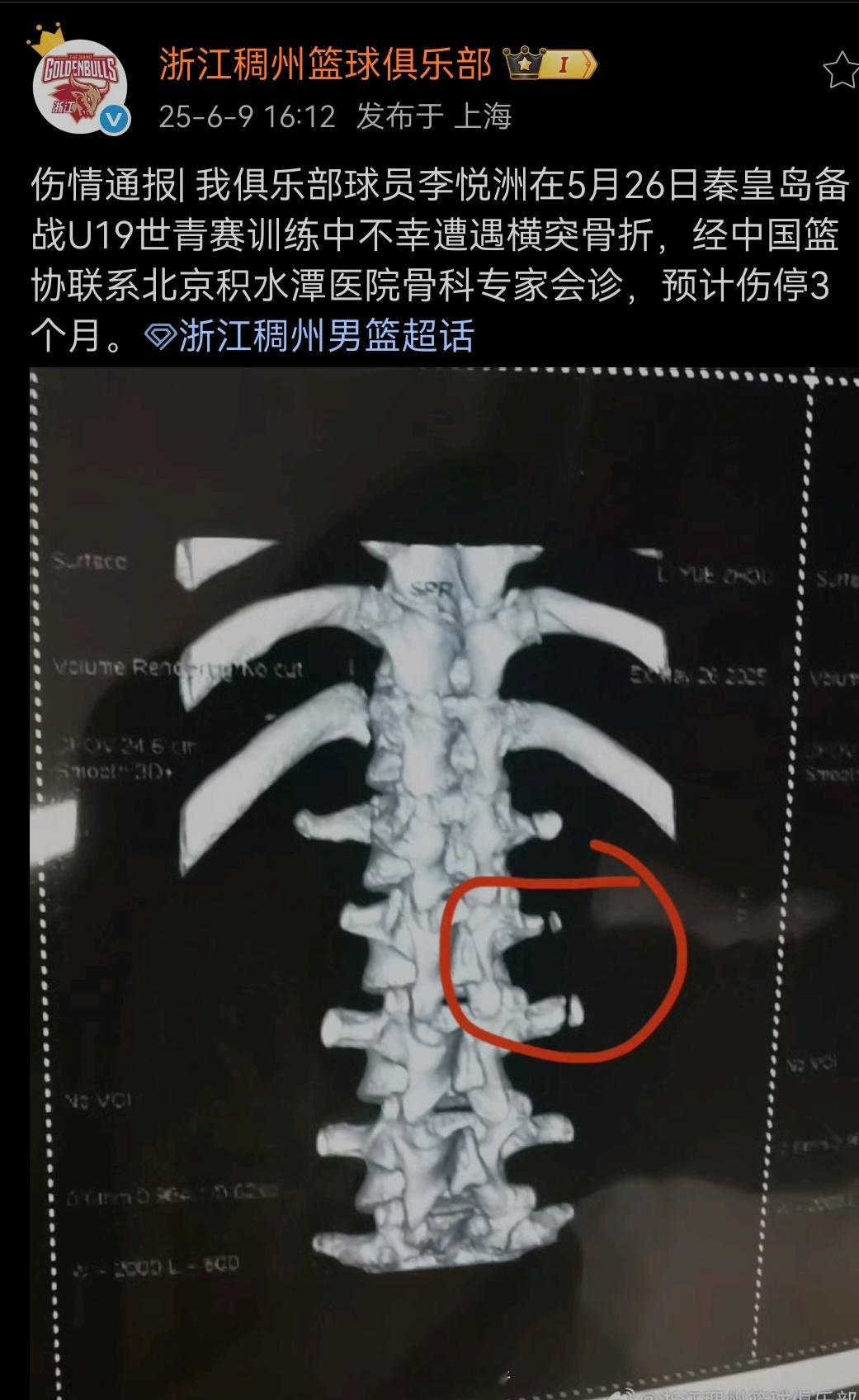 李悦洲这不是跟曾凡博那个伤性质是一样的？[汗][汗]我的观赛搭子 ​​​