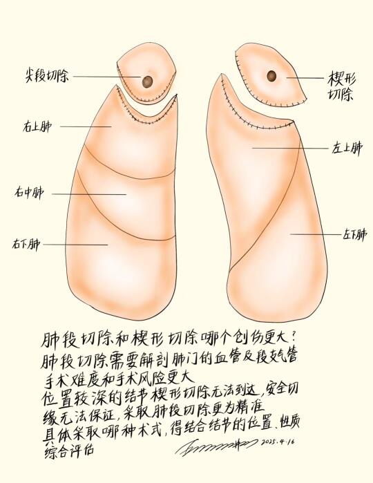 肺段切除和楔形切除哪个创伤更大？