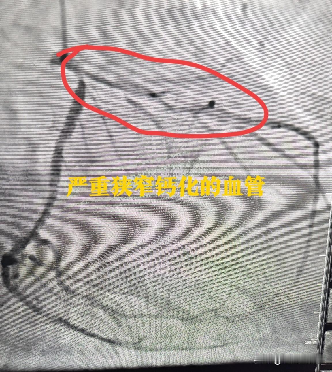 80 岁老人心脏支架手术中突发胸痛，一台风险又高又惊险的手术。80 岁老张平常没