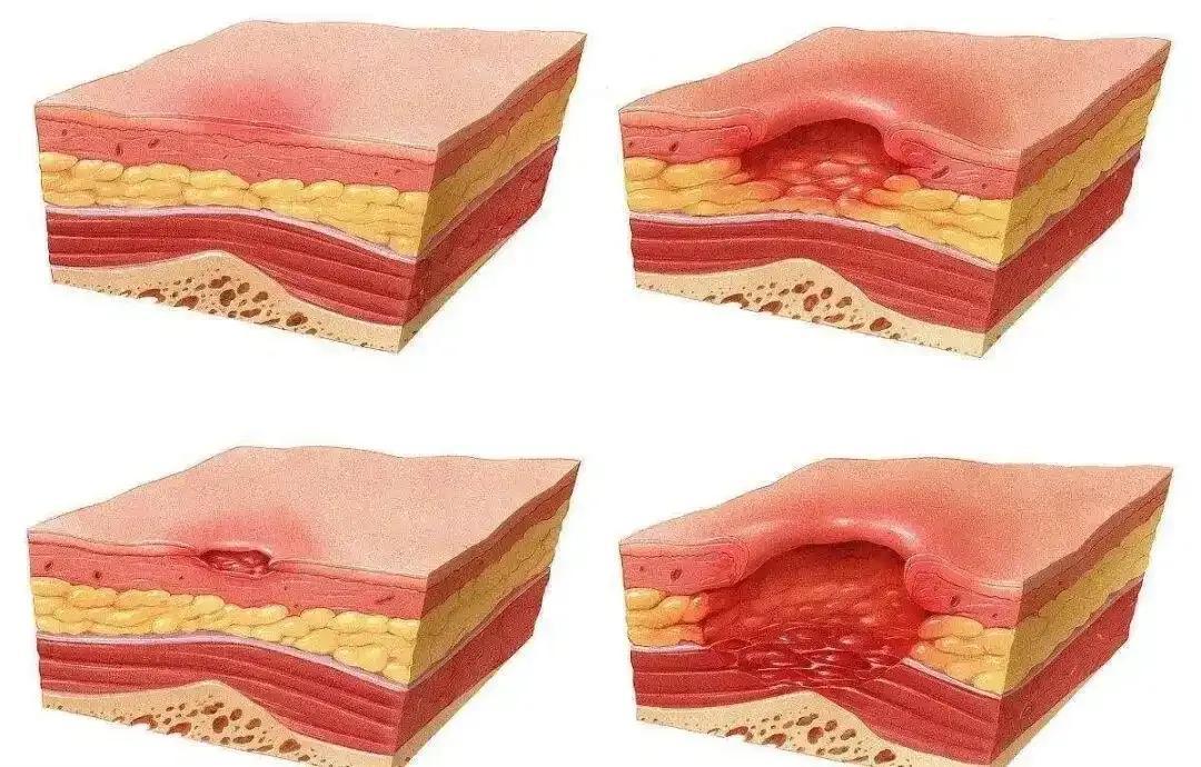 21岁女生小林因颈椎疼休学，寒夜过量服用安眠药后开着电热毯整夜未翻身，醒来后臀部