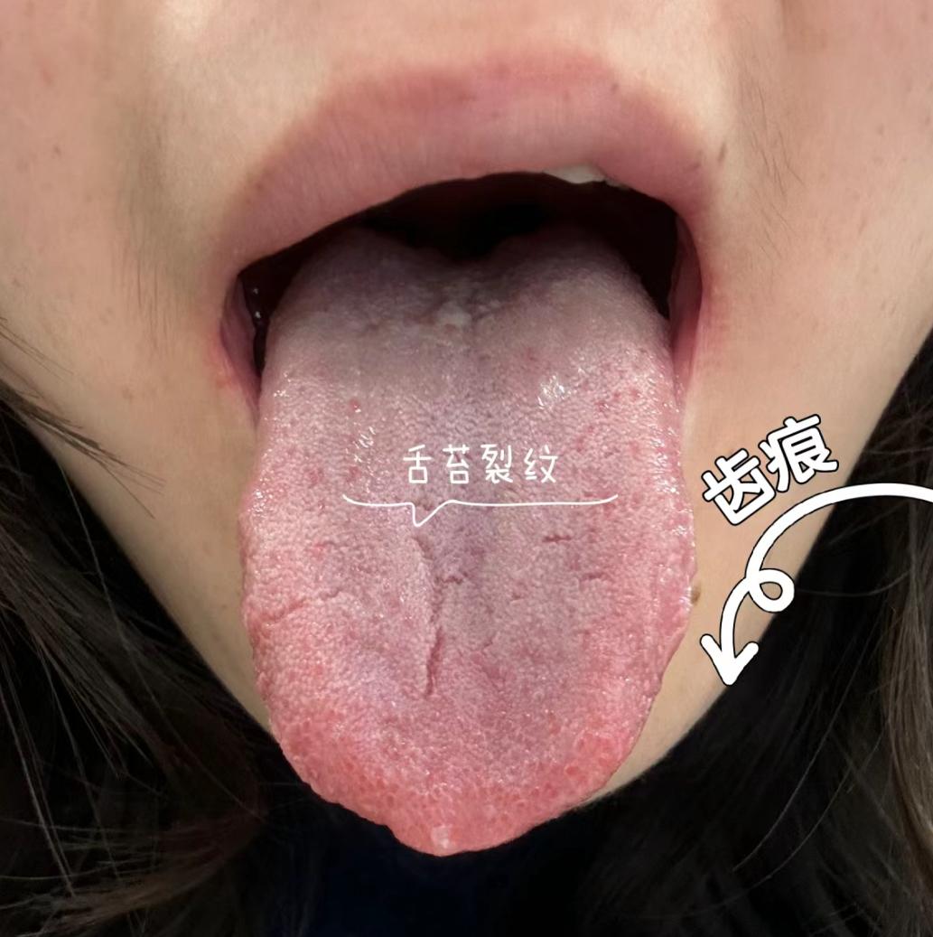 脾胃是有情绪的器官，也是很难调养的疾病之一
看这个舌象，舌头裂纹分叉了，还有齿痕
