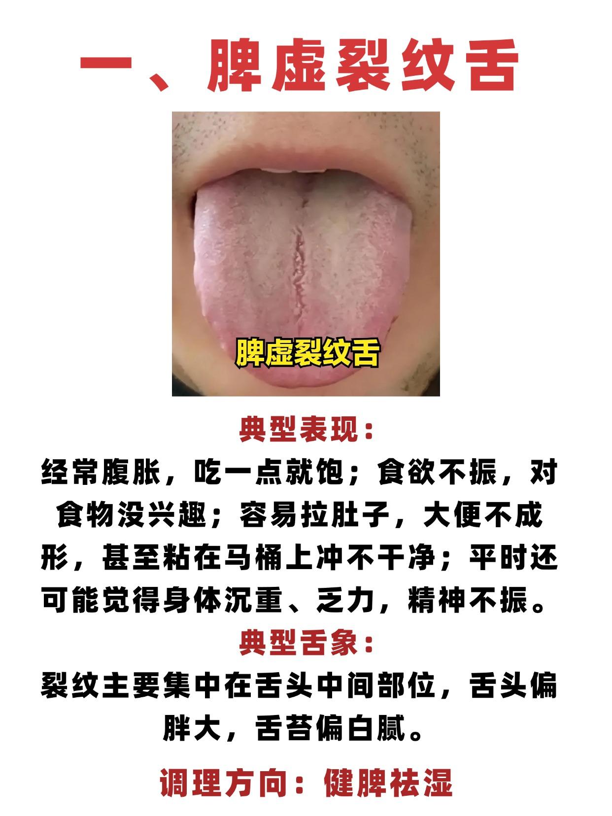 脾虚裂纹舌，肾虚裂纹舌，肾精亏虚裂纹舌