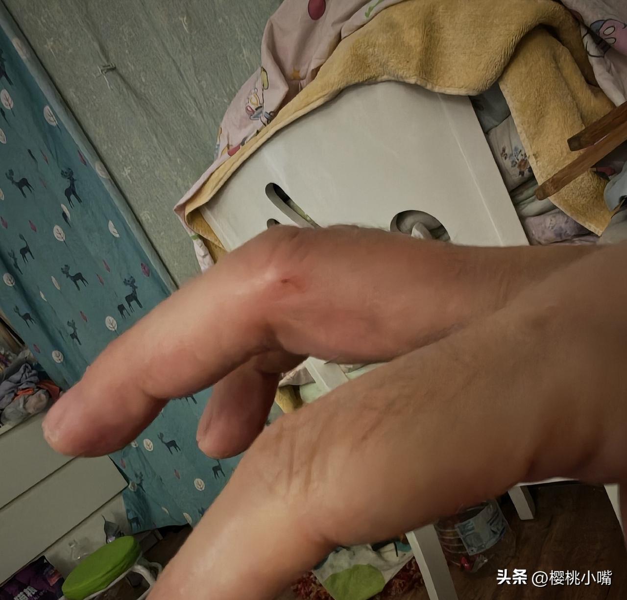 昨天晚上喂流浪猫被抓伤，正焦虑要不要打疫苗，今天上午去早市买菜，又一脚踩西瓜皮上