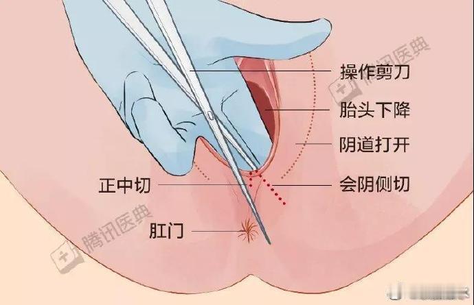 顺产时“下面”必须挨一刀吗？真相是......很多计划要孩子的女生都非常害怕顺产