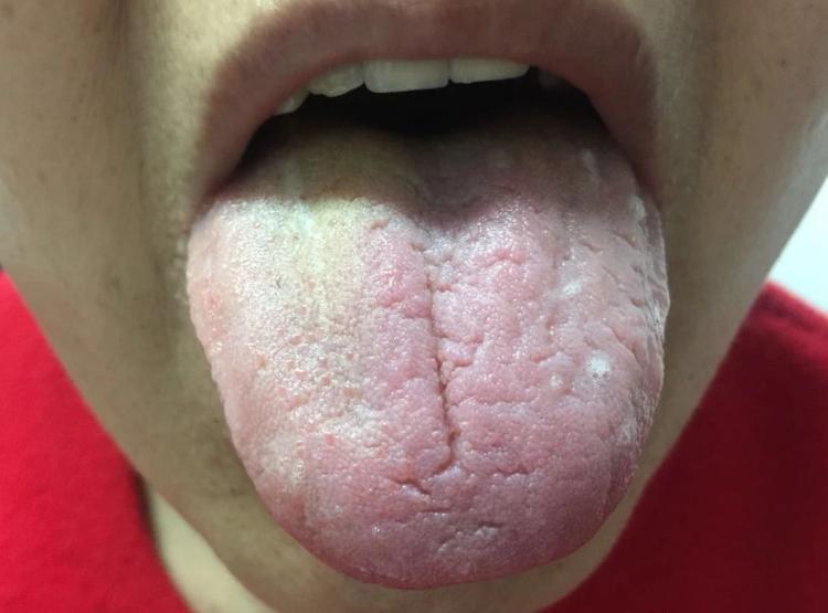 这个舌像的主要特点，一个是裂纹，一个就是僵硬之像
整体病机是精亏土败，木枯风燥，