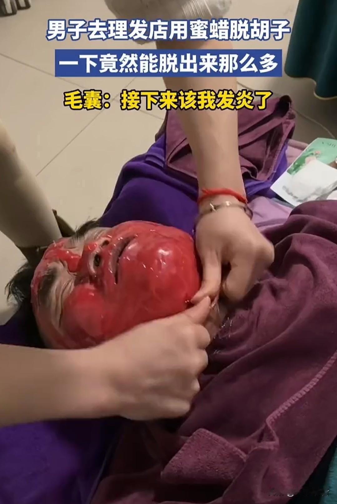 近日，河南大哥理发店蜜蜡脱胡子直接封神😂
一撕拉出一大片，毛囊集体离家出走，评