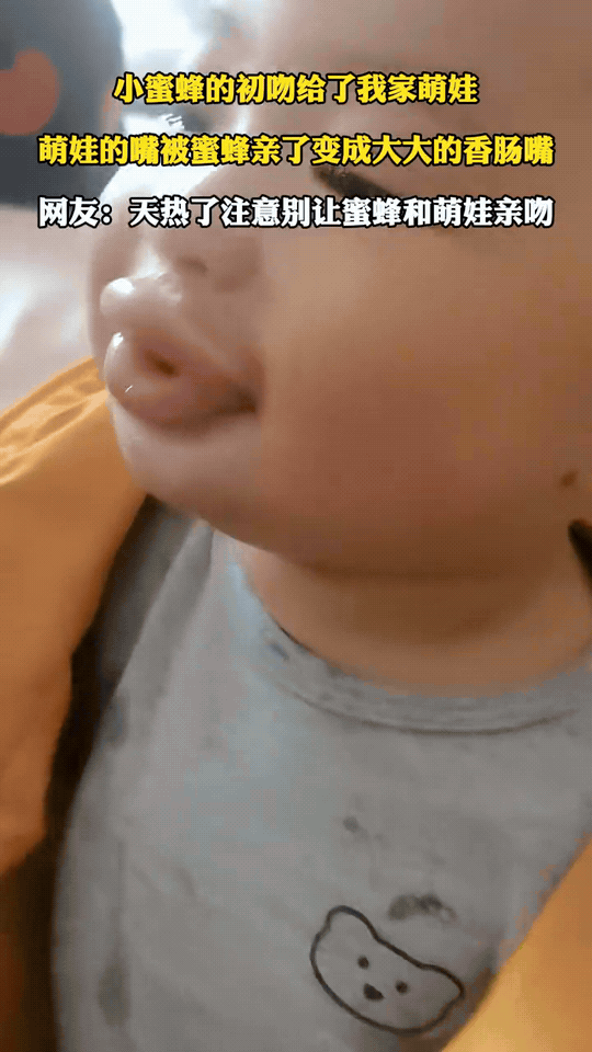 这是被蜜蜂“强吻”后的真实后果！
 
网友家的萌娃被蜜蜂蛰了，小嘴直接肿成了“Q