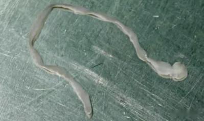 脑内8厘米寄生虫从一位61岁女子的脑内，医生竟“活捉”出一条长约8厘米、仍在蠕动