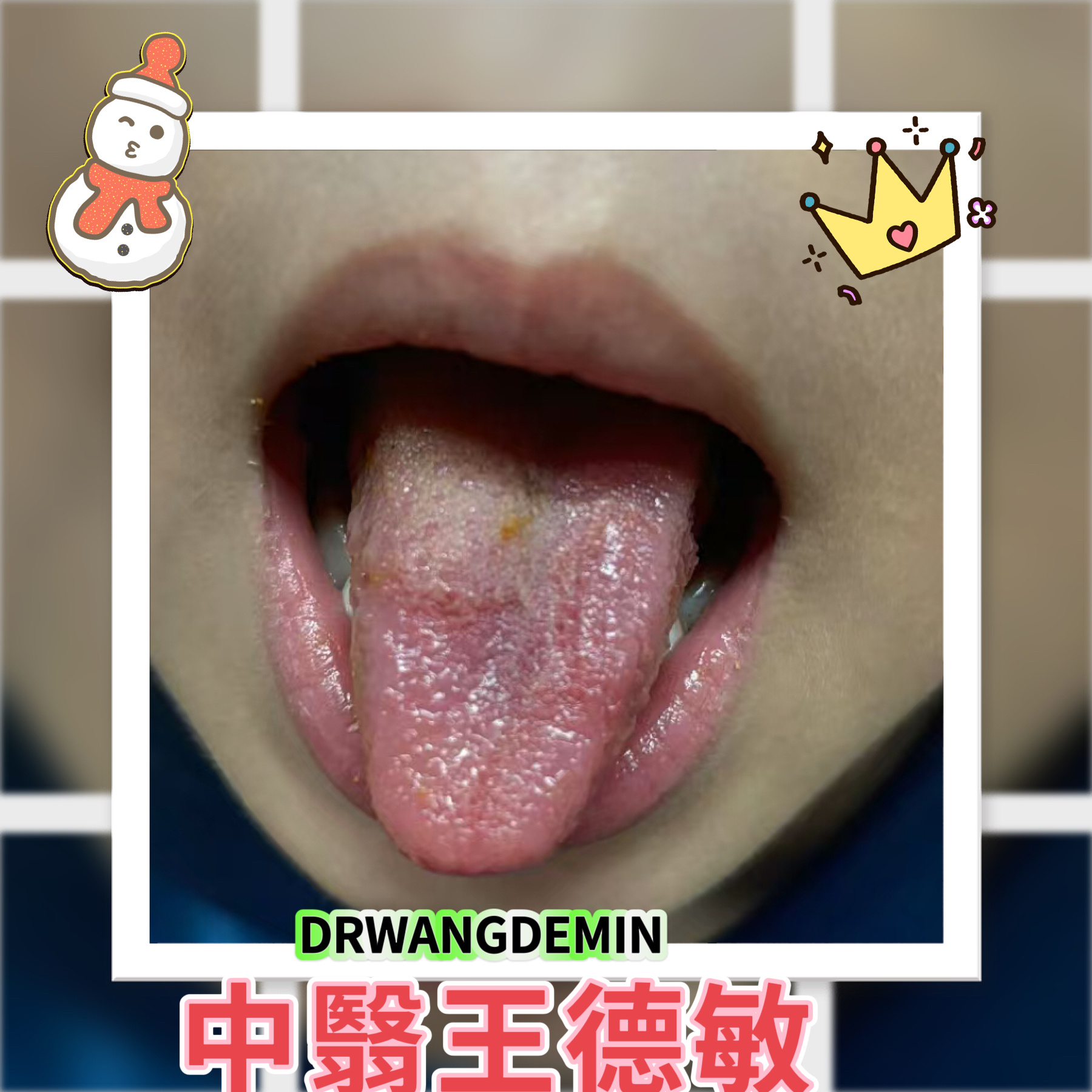 #中医##育儿专家说# 地图舌是怎么形成的❓1⃣滥用药物，抗生素，过量使用抗生素