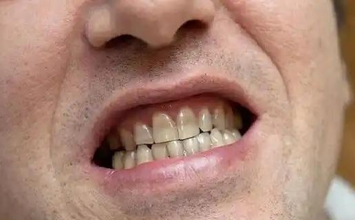 很多人把牙周炎当成小毛病，刷刷牙、漱漱口就能解决。事实上，它远比想象的复杂。牙周