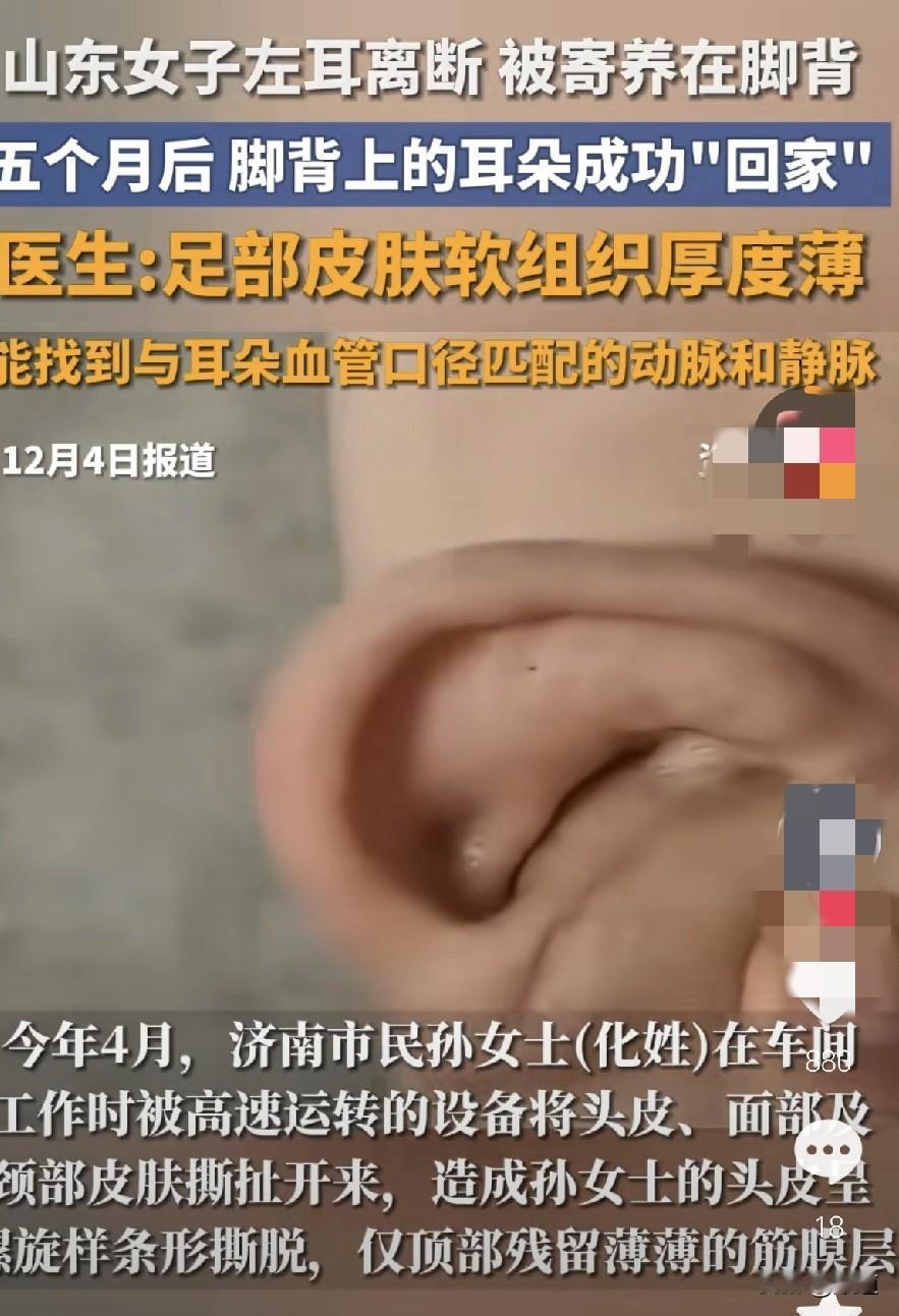 现在的医学也太发达了。
25年4月，山东济南的孙女士在车间被设备所伤，导致左耳离
