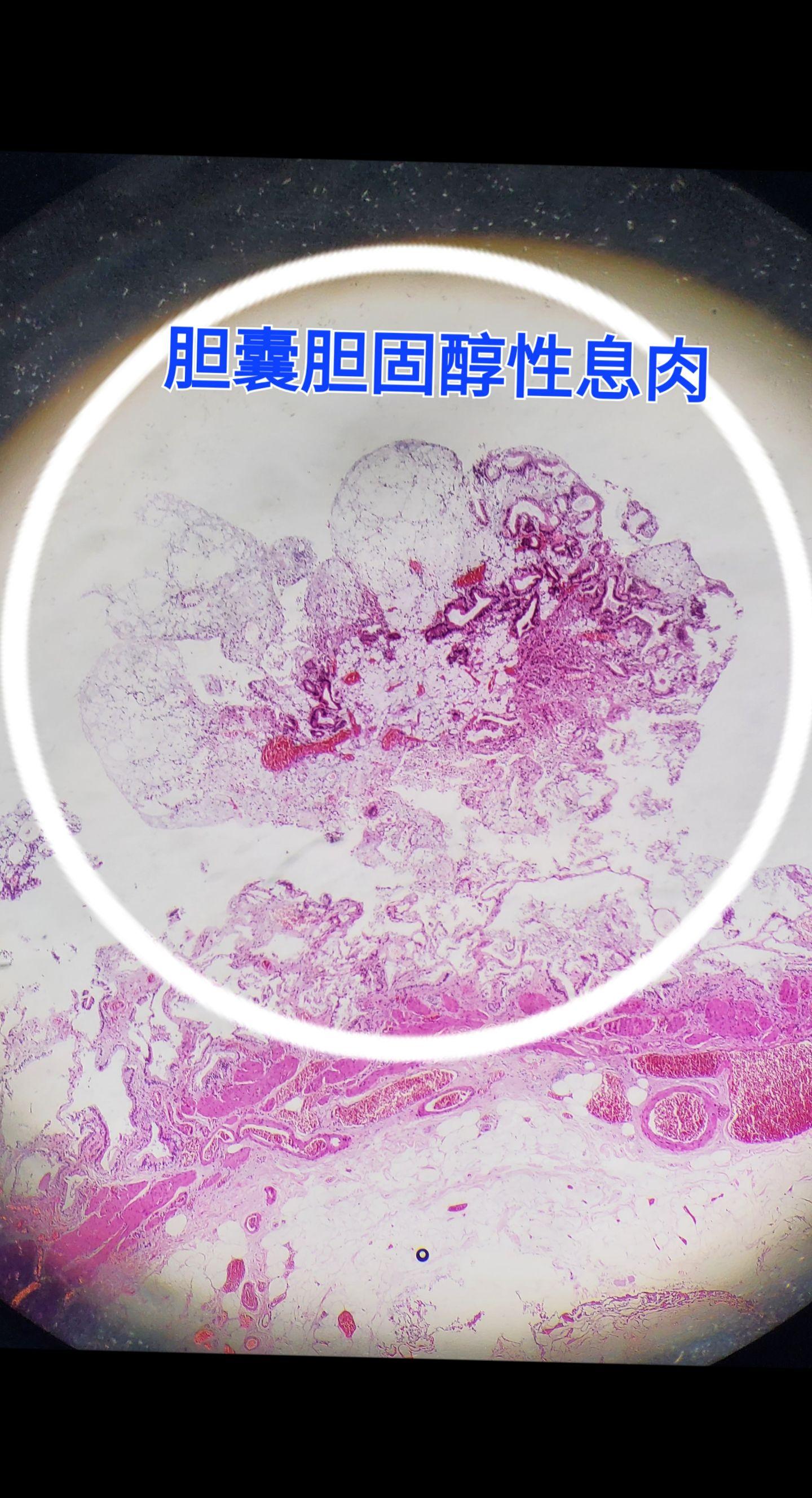 胆固醇性息肉