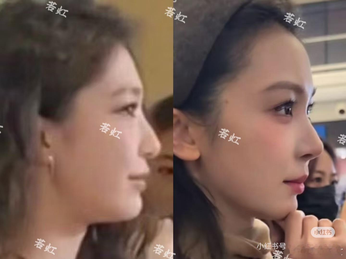 曝易梦玲整容老实说，看了一圈易梦玲的旧照和新图，鼻子确实变化挺明显的。但她那个B