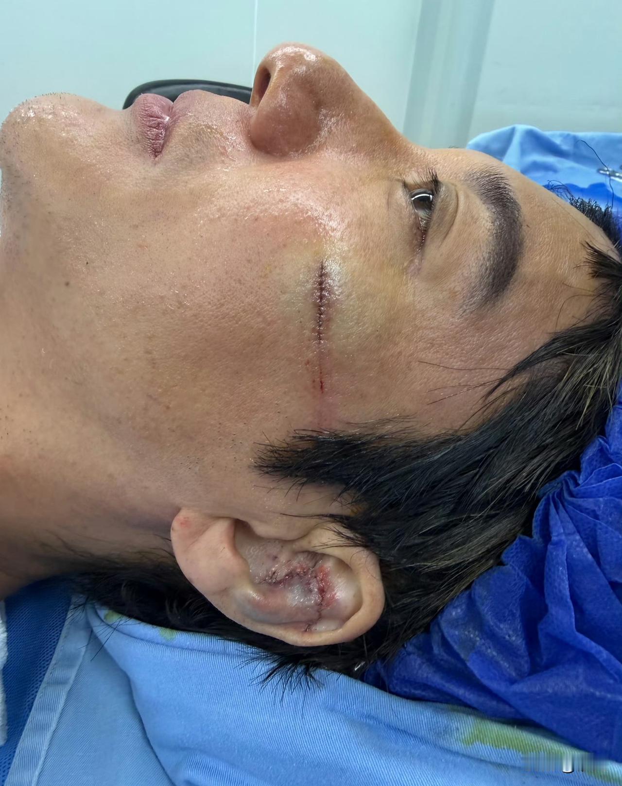 王力宏摔倒受伤缝了39针

王力宏本人写道：“今晚演出时脚被自己的钢丝卷到了，给