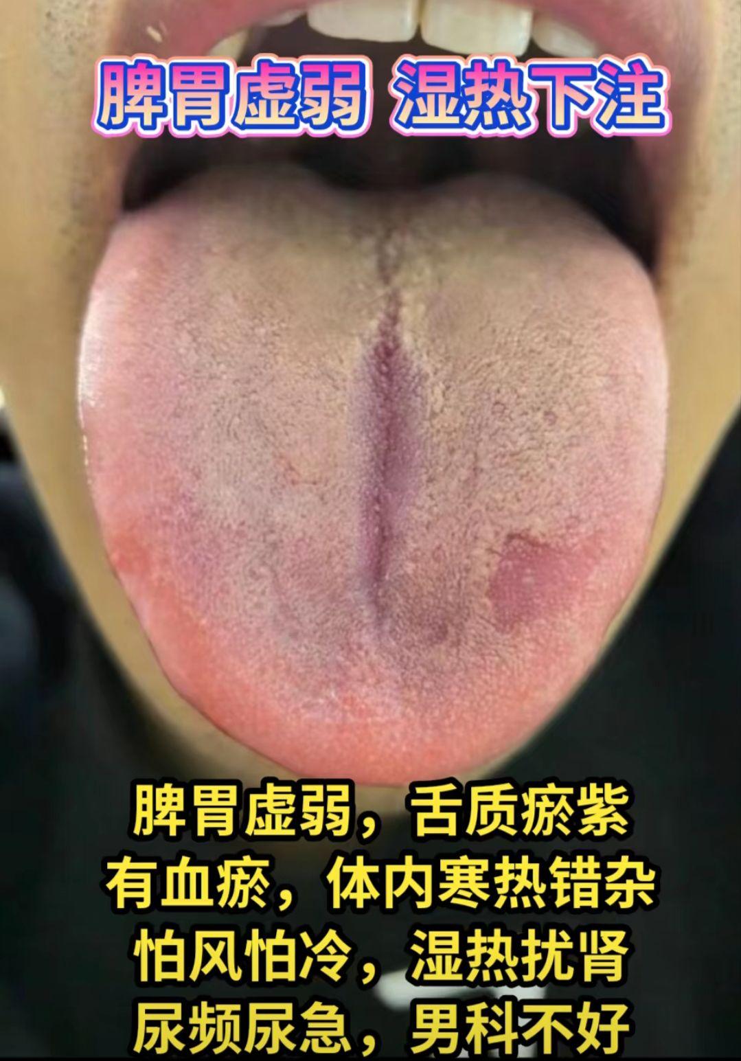 脾虚舌象大分析 朋友们进来看看吧