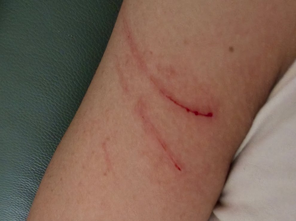胳膊被猫抓了，没事吧？[捂嘴哭] ​​​