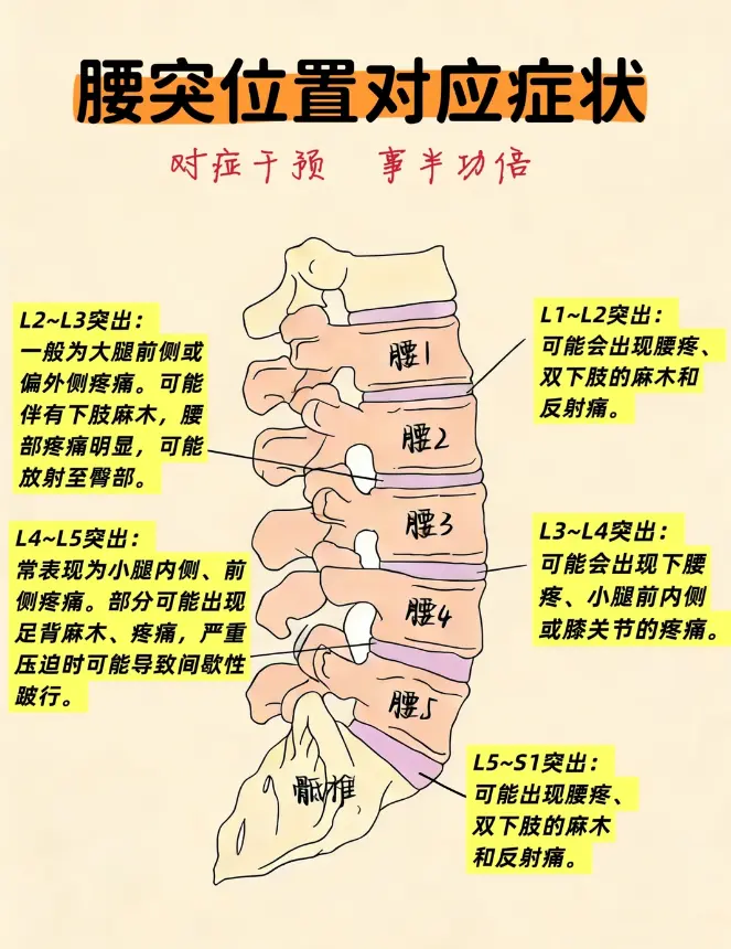🤣最近腰椎间盘突出发作疼痛难耐。 坐着十分钟以上，右腿大腿外侧和膝盖...