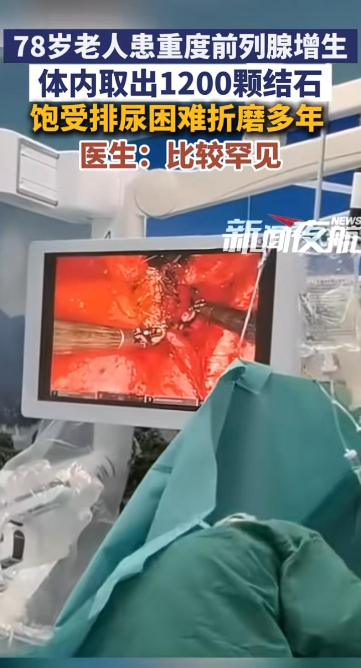 78岁老人憋尿险出大事！很多男性到老都忽视这个隐患
 
新闻夜航报道一则令人揪心