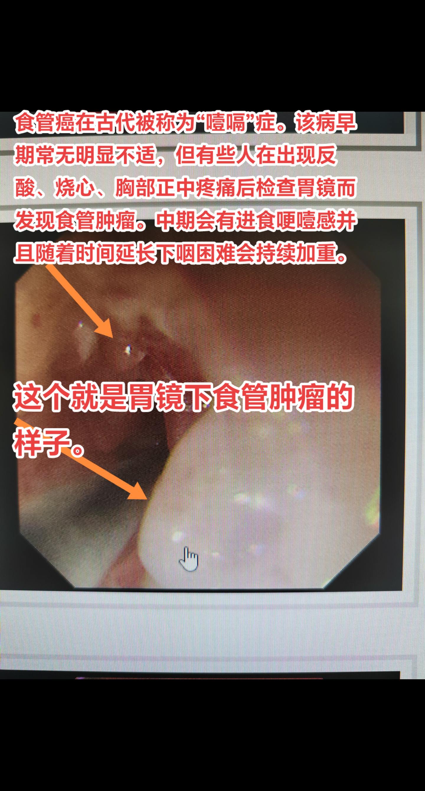 食管癌有哪些症状？食管癌在古代被称为“噎嗝”症。该病早期常无明显不适，但有些人在出现反酸、烧心、胸部正中疼痛后检查胃镜而发现食管肿瘤。中期会有进食哽噎感并且随着时间延长下咽困难会持续加重。