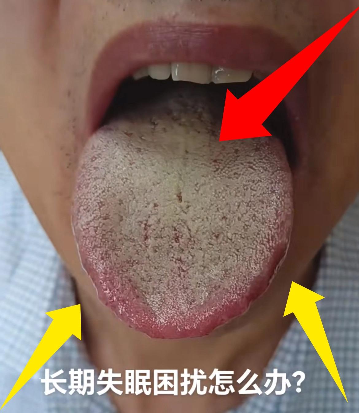先把药停停吧！你不清湿热，还在猛猛补肾，就算补十年也没用[黑线][黑线][黑线]