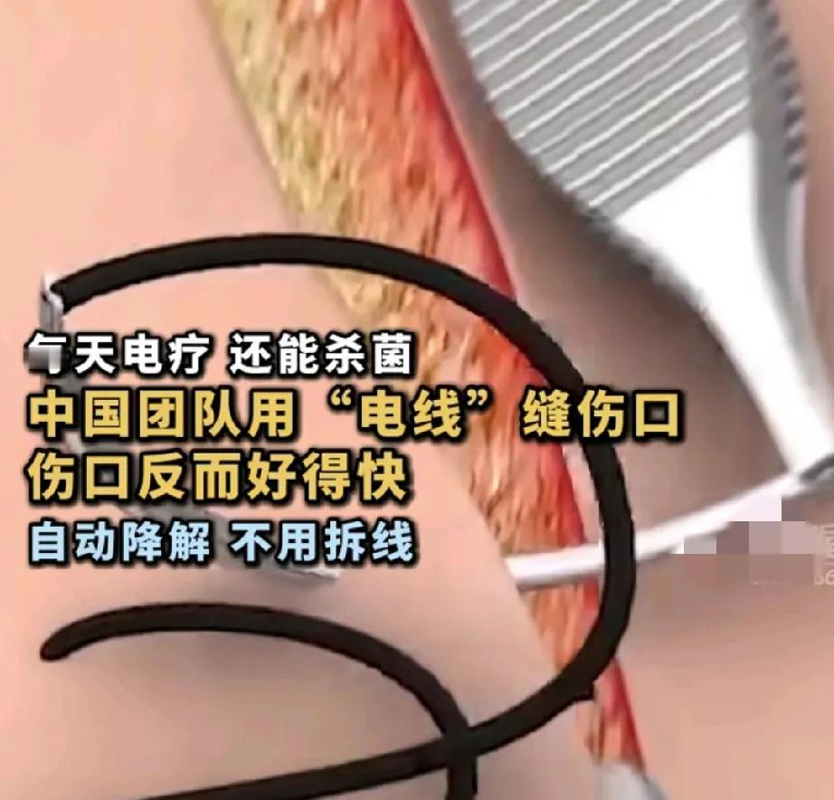 我们赢了！我们中国才是牛的。这次将打破技术壁垒，中国团队用能通电的缝合线来缝伤口