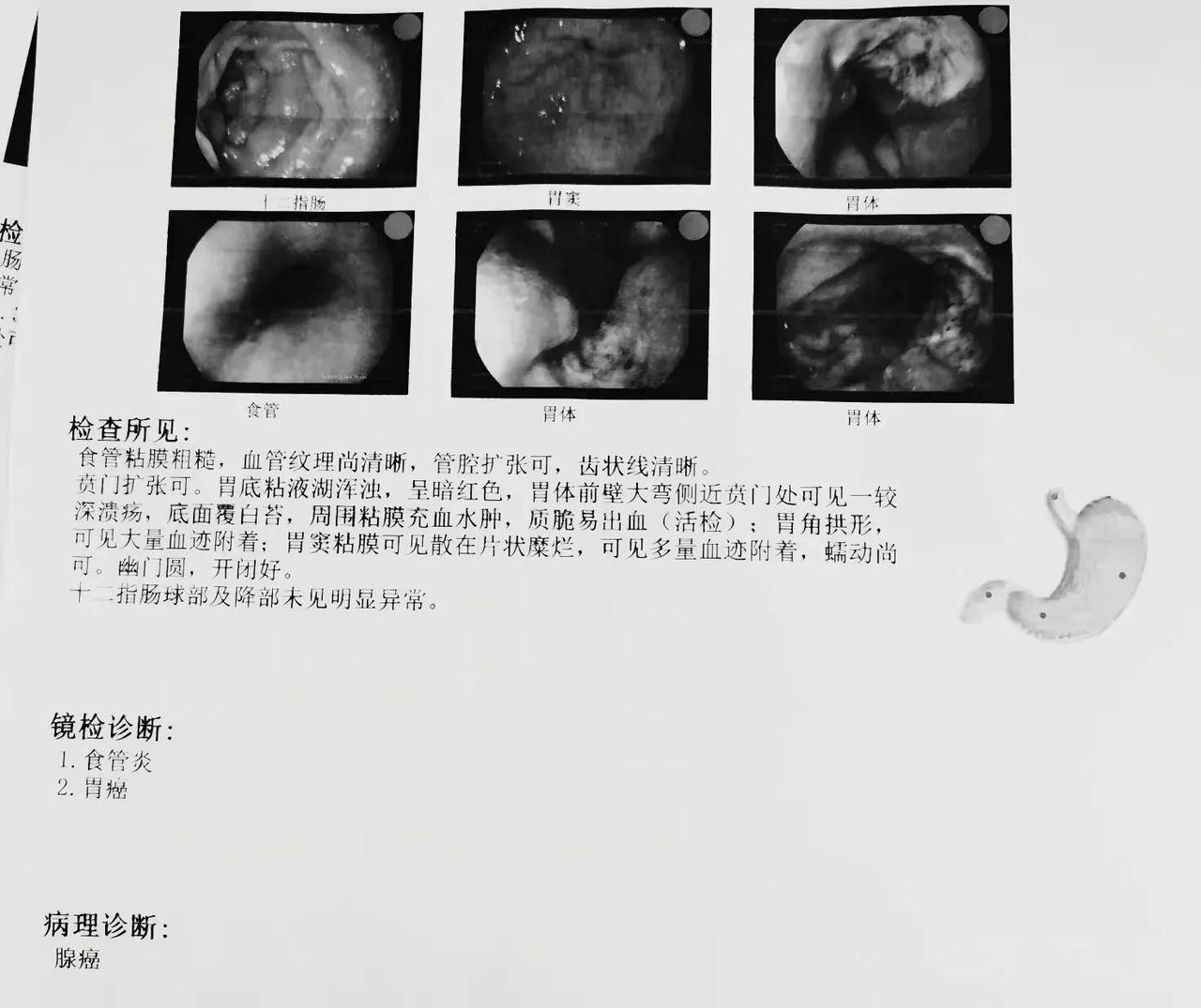 乏力加头晕居然同时查出胃癌＋肠癌！。这位老哥，顿顿有酒，餐餐有烟。为这事，老婆跟