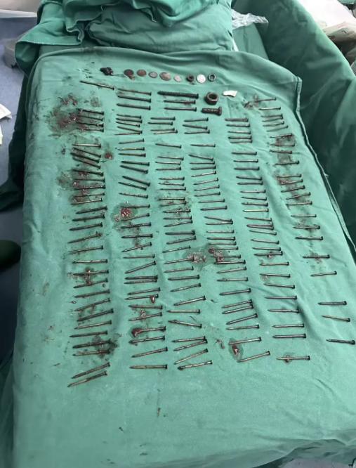 解释不清了！云南，一男子腹部剧痛送医，医生检查后当场被吓退三分：他体内居然塞满了