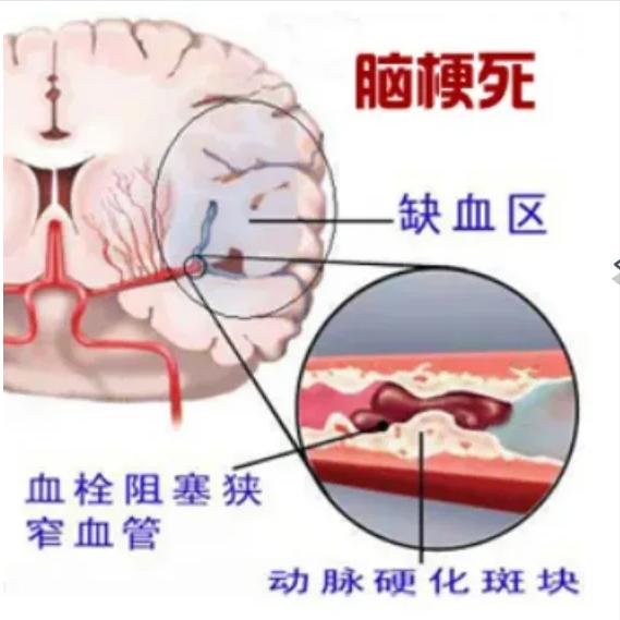 脑梗最怕这4个“隐形杀手”！第一个很多人中招却不知道
总听说有人平时好好的，却突
