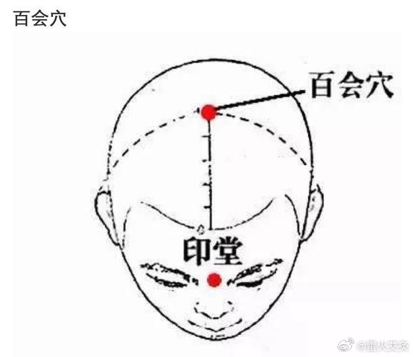  治疗原则：温阳理气，祛风除湿，流畅气机。可以督脉灸，悬灸大椎，两侧期门，百会穴
