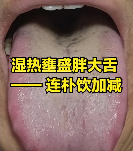 湿热壅盛证（胖大舌）的舌象解析及连朴饮加减调理
中医认为“湿邪黏腻阻气机，热邪炎