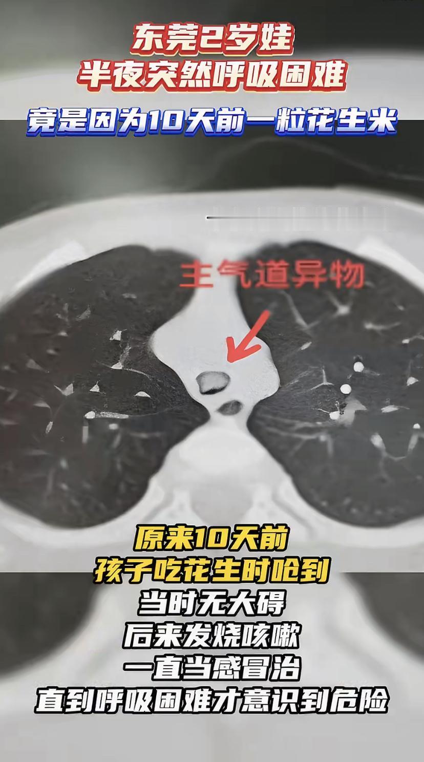 2岁娃半夜喘不上气，脸都憋青了!家长起初还说没呛过东西，结果CT一拍，气管里竟卡
