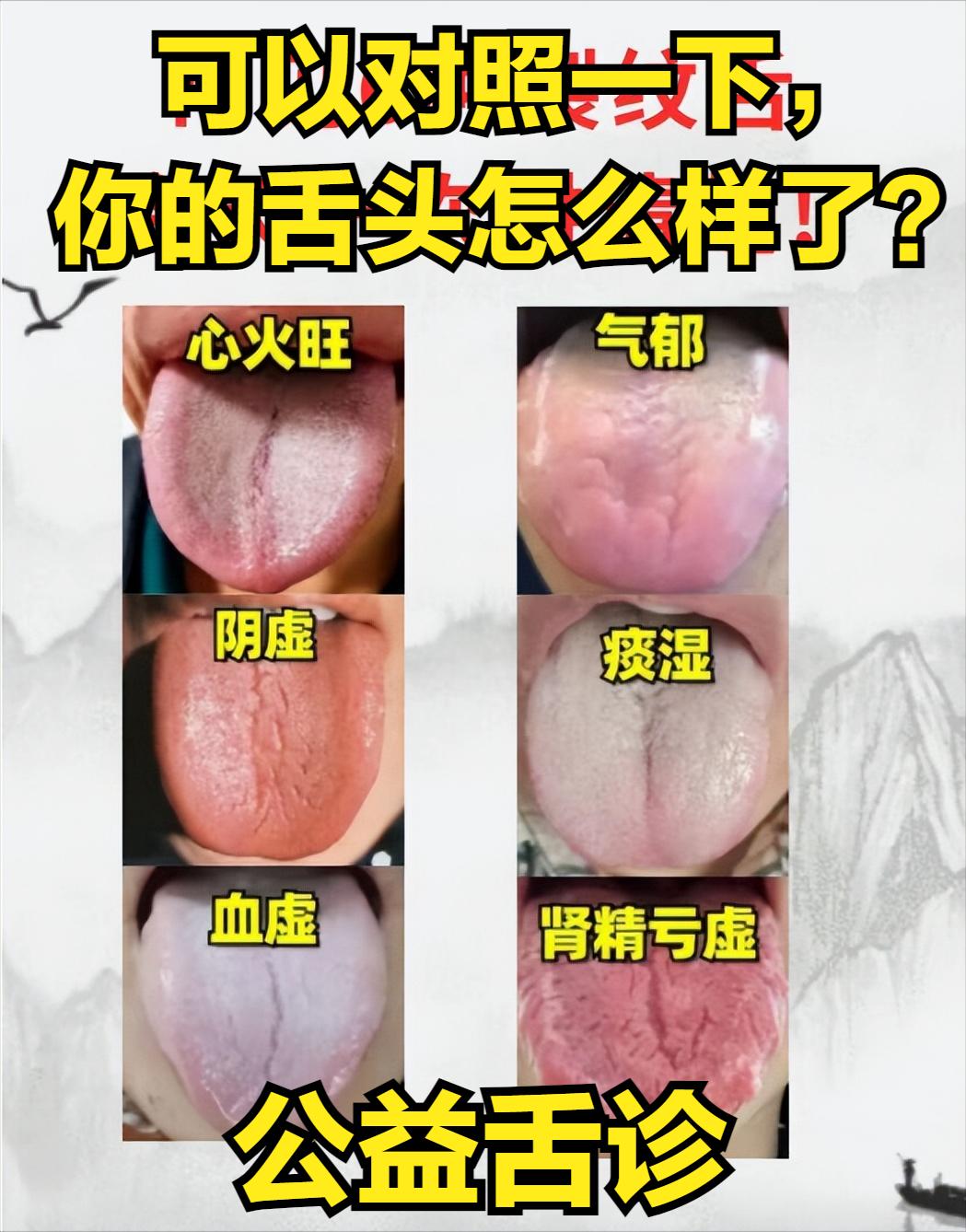 朋友们好，我是王医生[作揖]，今天是舌诊挑战的第14天，挑战看1414个舌头！