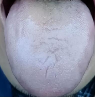 同为“泄”精，但是一定要注意，用手的危害，远大于男女！！
 
就像是这位患者：年