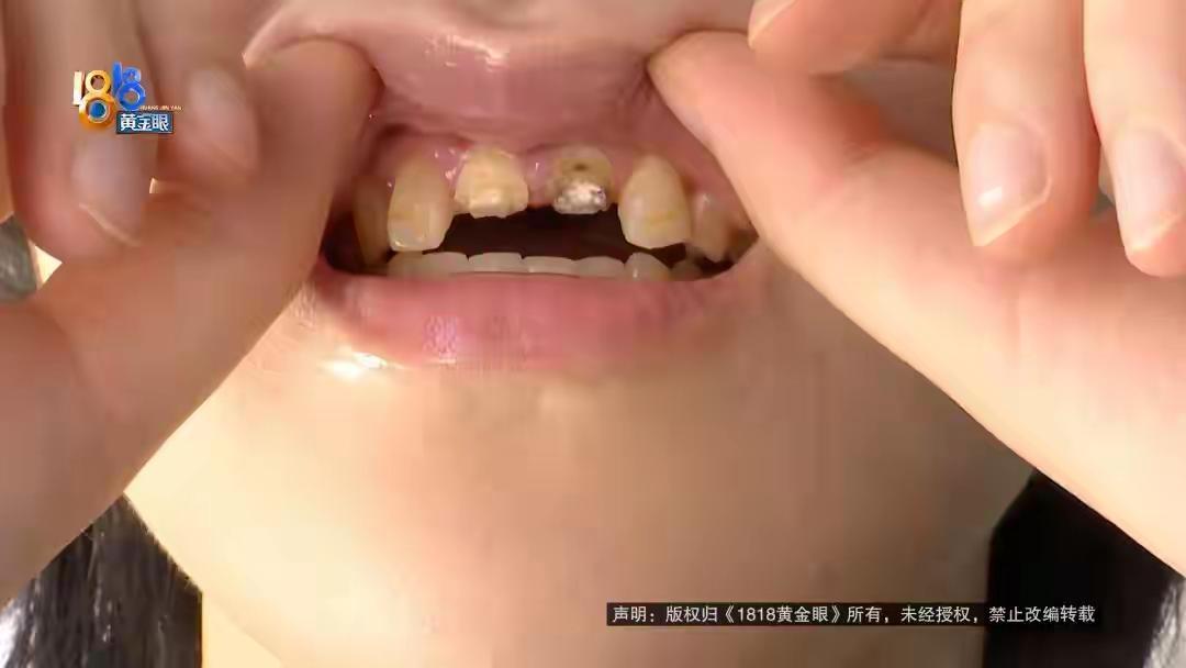 还是杭州“歪人”厉害，一拳打断女生两颗门牙
女大学生和俩女同学加一男朋友凌晨在金