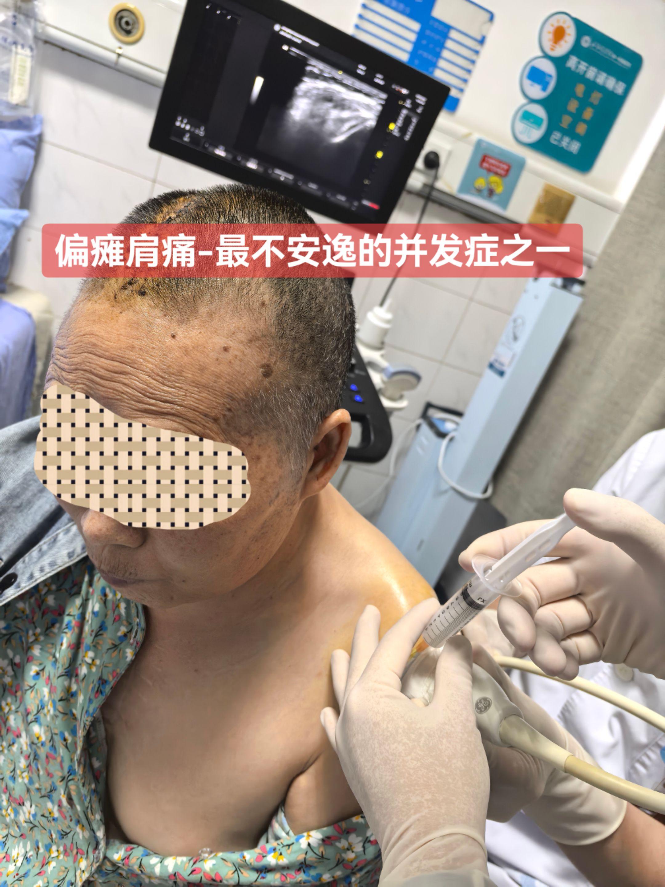 超声引导下肩胛上神经阻滞+肩峰下滑囊注射治疗，不要问为什么，只要打准了...