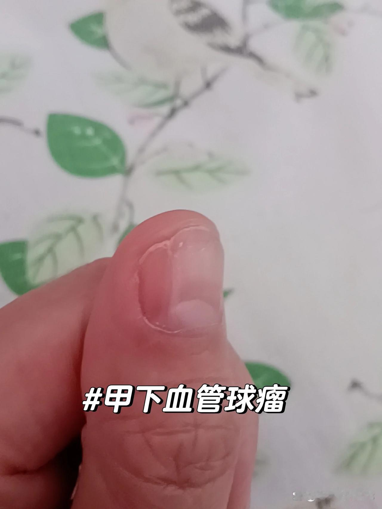 脚上长出水疱，抠破后竟蔓延出“菜花”一样的肿块，一度被怀疑是恶性肿瘤，甚至“菜花