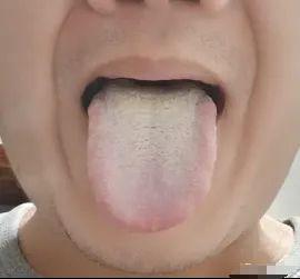 痰湿过重，舌苔厚重发白，湿邪困扰脾胃
舌苔厚重且发白，几乎将舌头全覆盖，这是体内