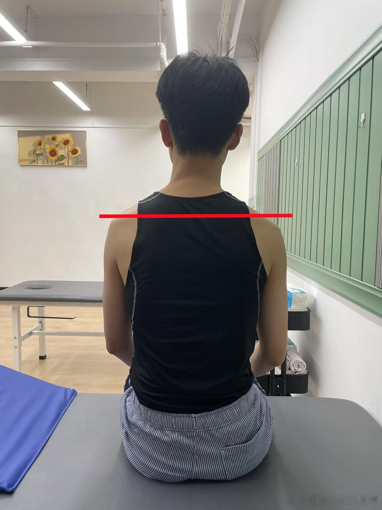 高低肩矫正  来看一个调整体态的例子。广州店这位小哥高低肩比较明显，再加上有翼状