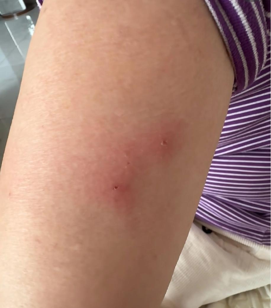 我妈胳膊上莫名长了几个红点点，一开始只是痒得厉害，现在还肿起来了，看着特别揪心。