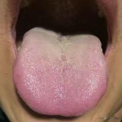 舌头红成这样了，还在补阳，没搞清楚自己是什么病，就开始补，是最愚蠢的调理想法

