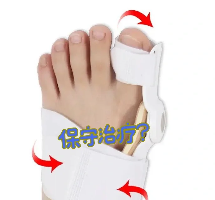 拇外翻为啥没有保守治疗？