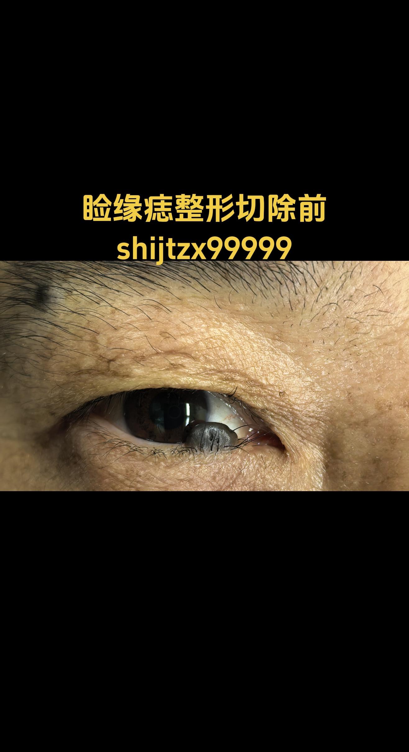 睑缘痣。睑缘痣采用整形切除＋皮瓣修复术，对眼睛外观影响较小。