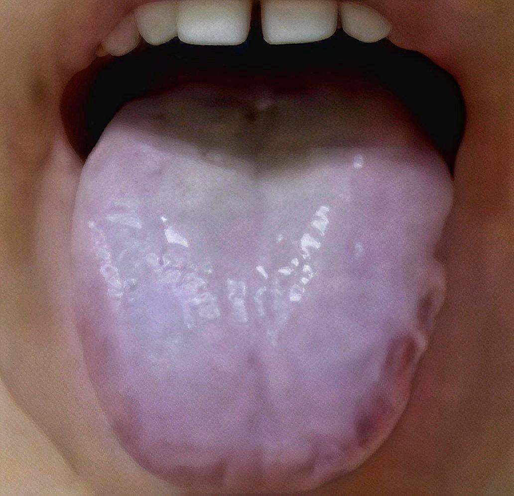 痰湿+阳虚+肝郁+脾虚，不忽视这4点的话，就好调理   这位患者，主诉...