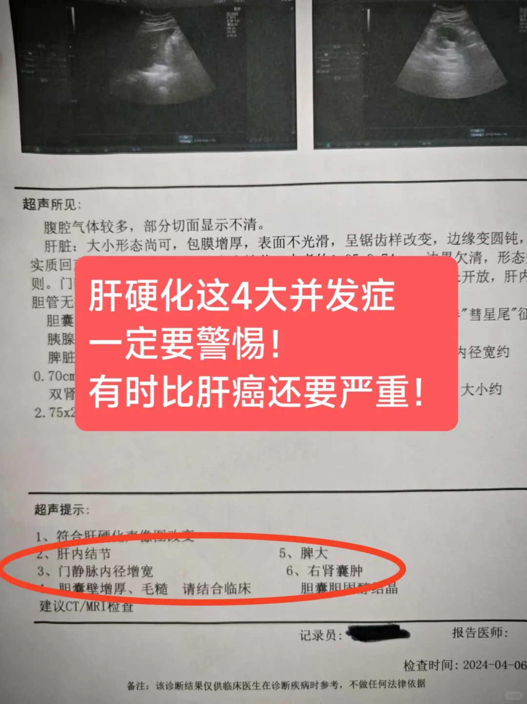 肝硬化4大并发症一定要警惕！