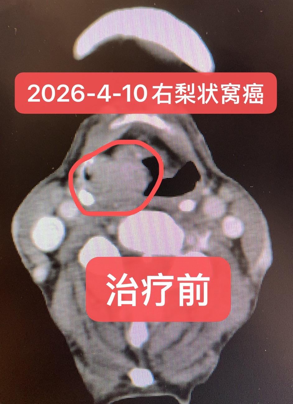 头颈鳞癌：梨状窝癌的治疗。患者男，64岁，2025-11-05 行食管...