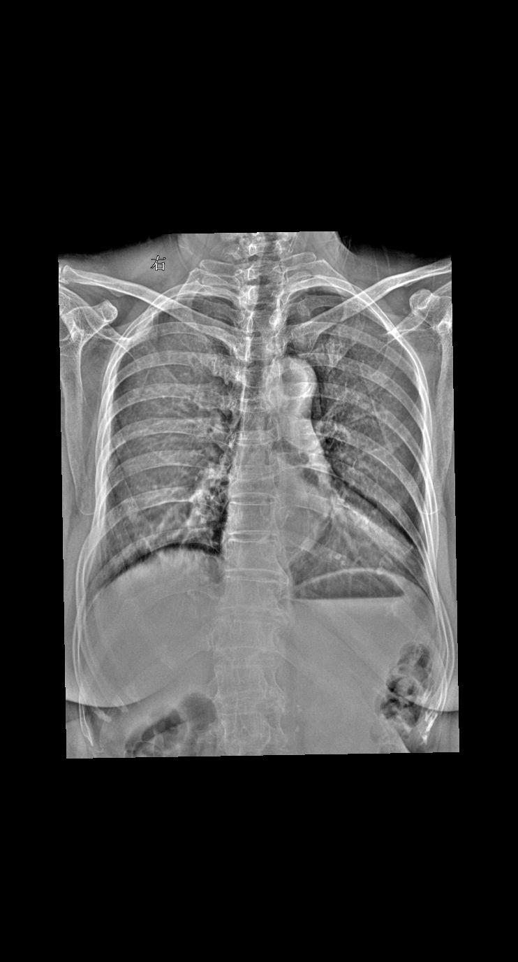 女74骨折一月复查