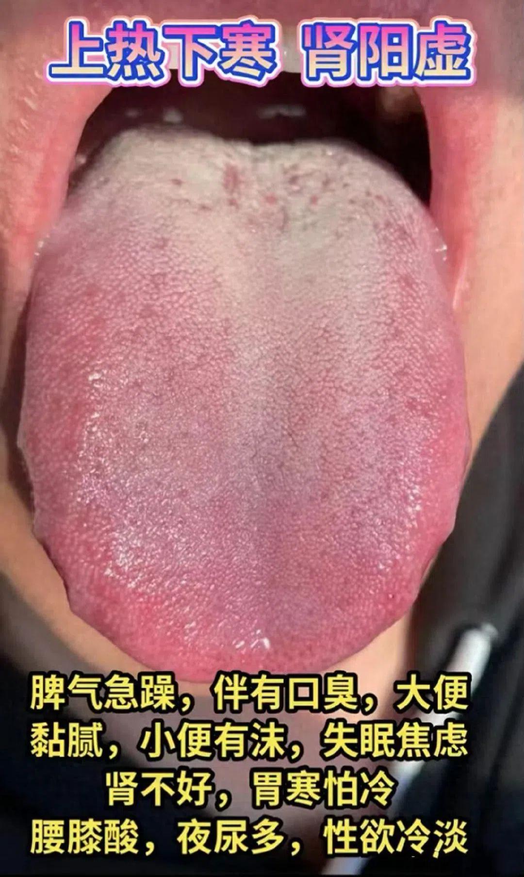中医免费舌诊——看完88个舌象！

又到周一了，今天继续帮大家看舌象！，前两天看